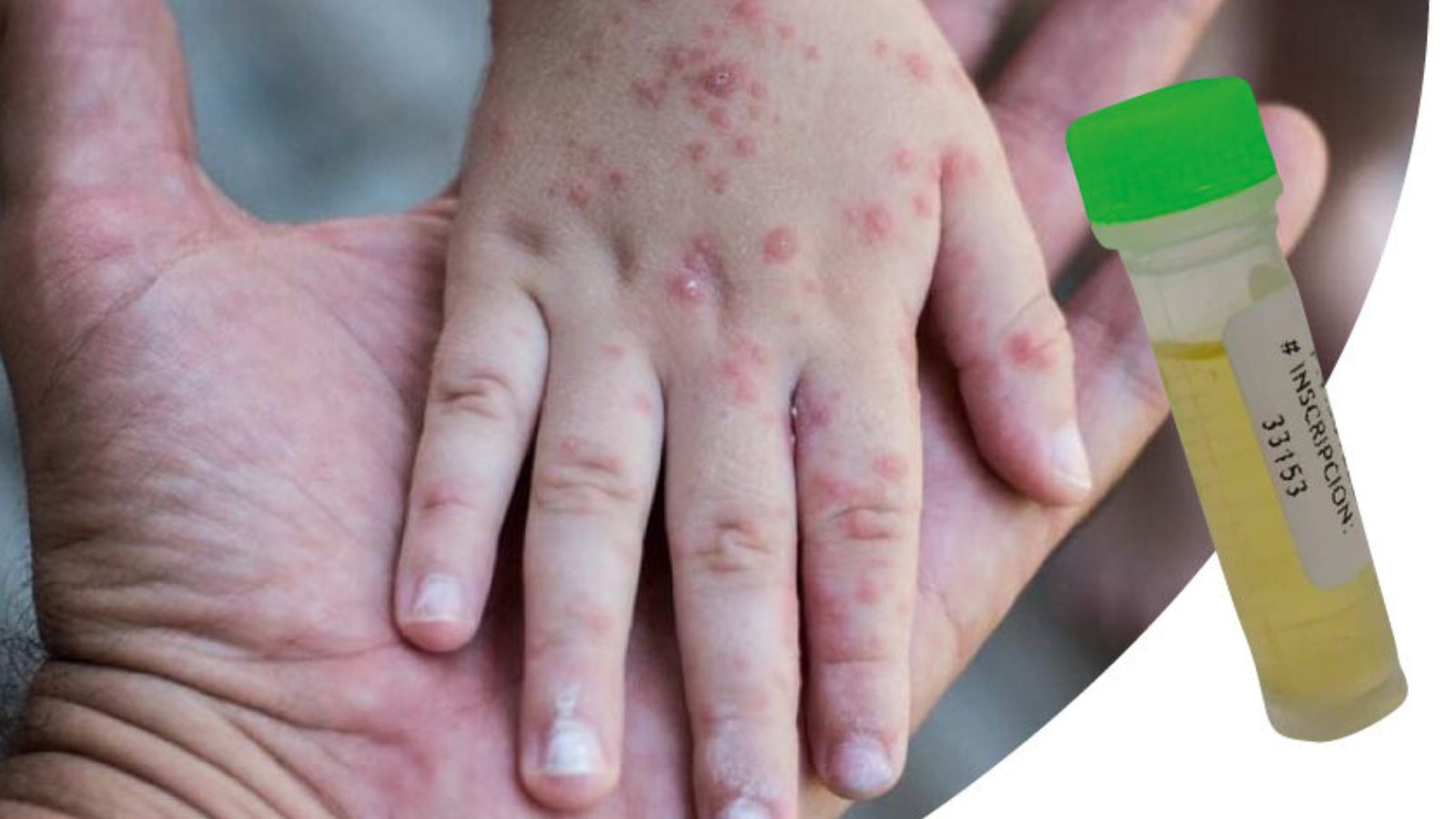 ¿Hay casos de la viruela símica en Guatemala