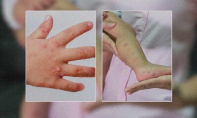 Brote de enfermedad mano, pie y boca afecta a más de 130 personas en Sacatepéquez