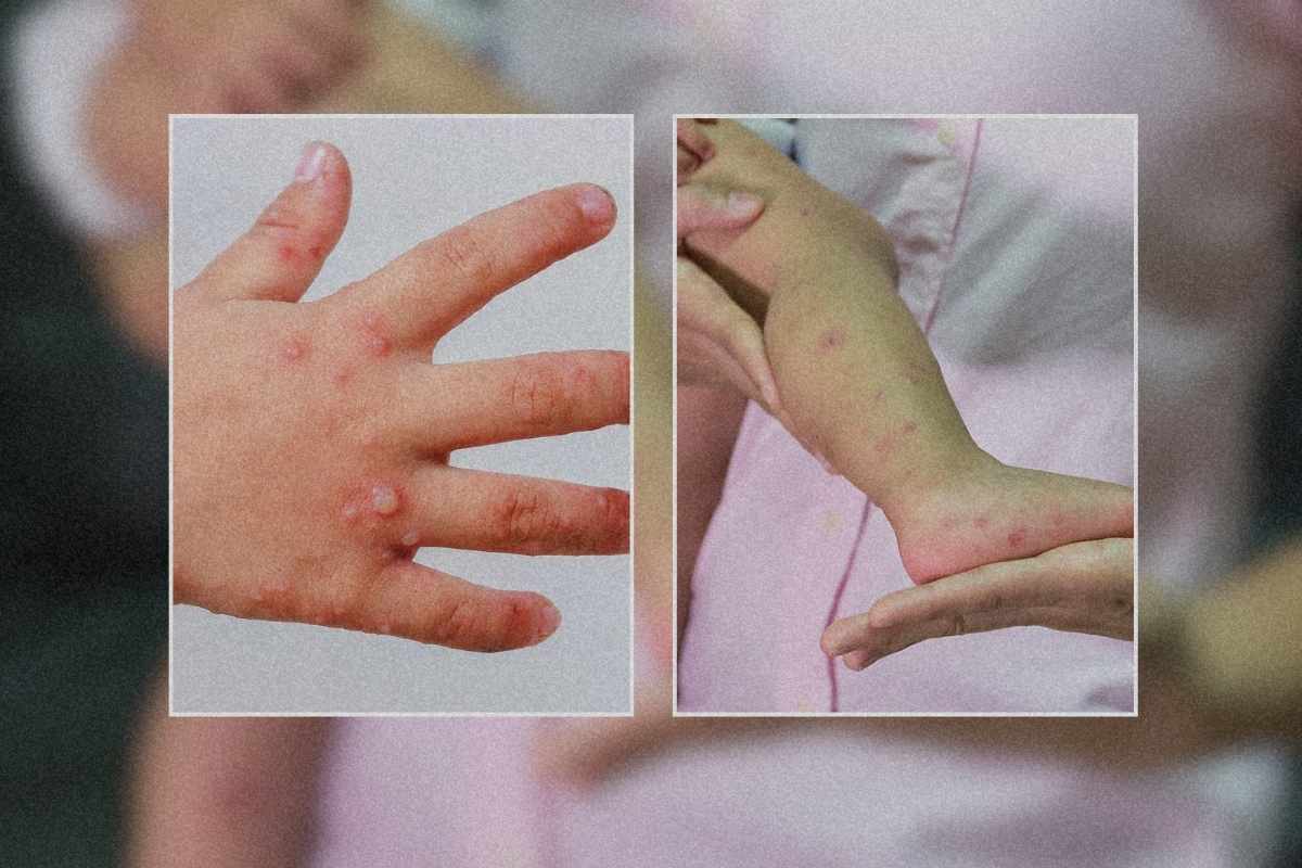 Brote de enfermedad mano, pie y boca afecta a más de 130 personas en Sacatepéquez