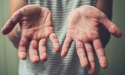 Sarampión reaparece y enciende alertas sanitarias en Guatemala