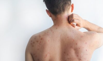 OPS alerta por repunte de sarampión en Guatemala