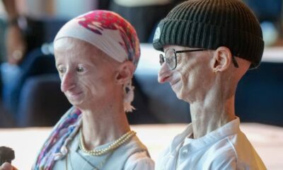 Michiel Vandeweert la historia del joven que vivió más allá de los pronósticos de la progeria