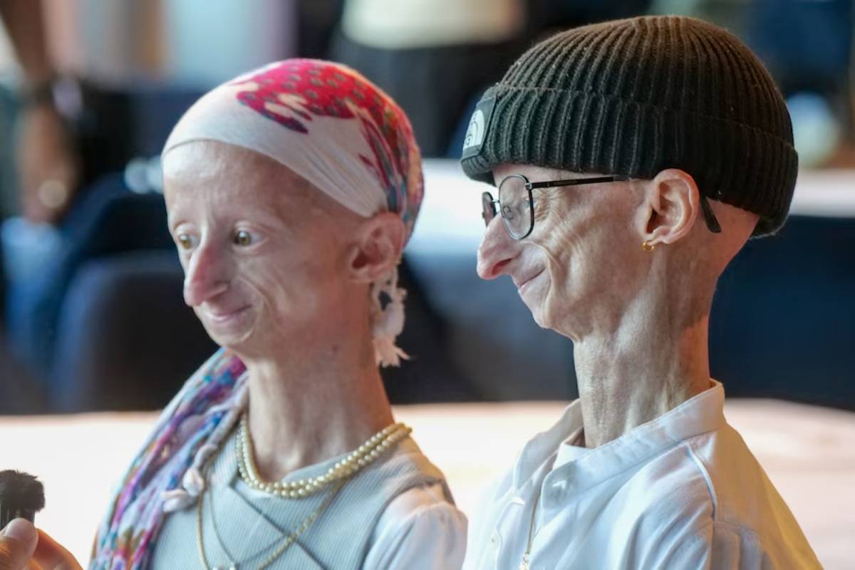 Michiel Vandeweert la historia del joven que vivió más allá de los pronósticos de la progeria