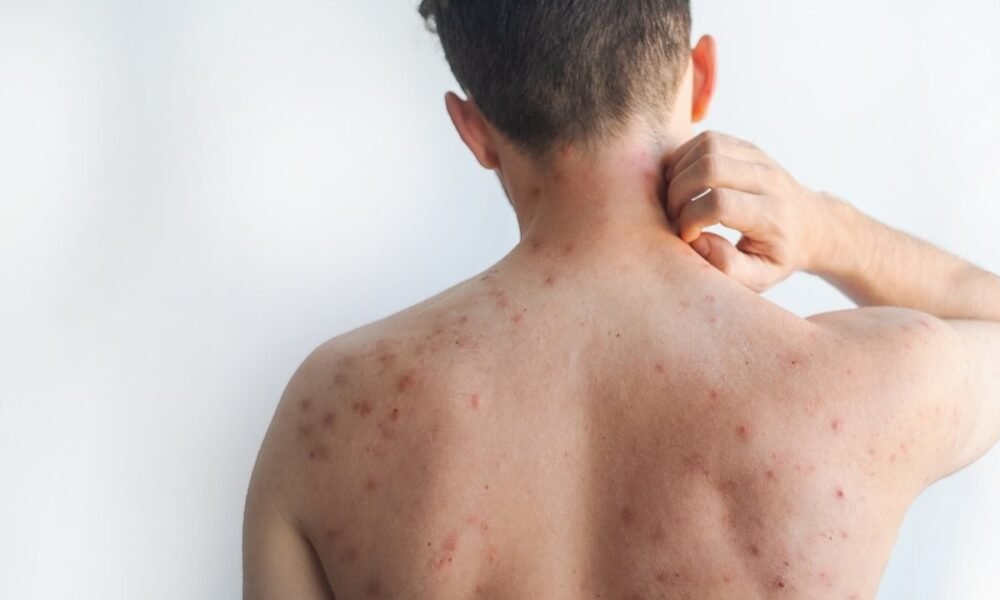 Sarampión 616 casos en Guatemala