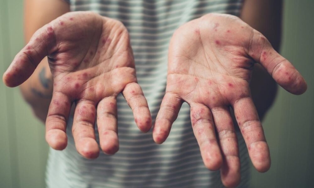 Sarampión se dispara 75 % en una semana en Guatemala