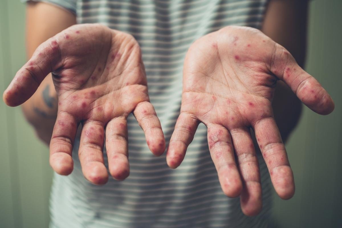 Sarampión se dispara 75 % en una semana en Guatemala